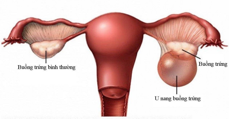 Người tiền sử có u buồng trứng dễ bị xoắn buồng trứng